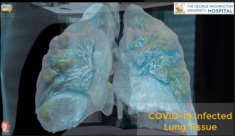 VR технология разкрива пораженията върху белия дроб на пациент с COVID-19